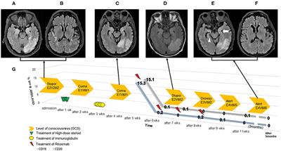 Case Report: The Use of Rituximab in Antibody-Negative Autoimmune Encephalitis